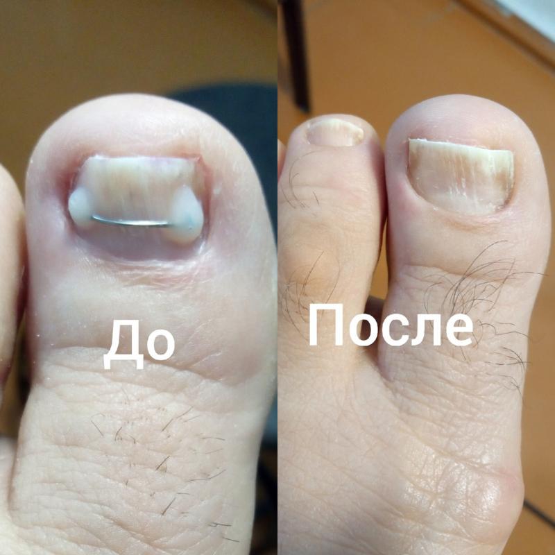 Подологический и эстетический педикюр. - Орск
